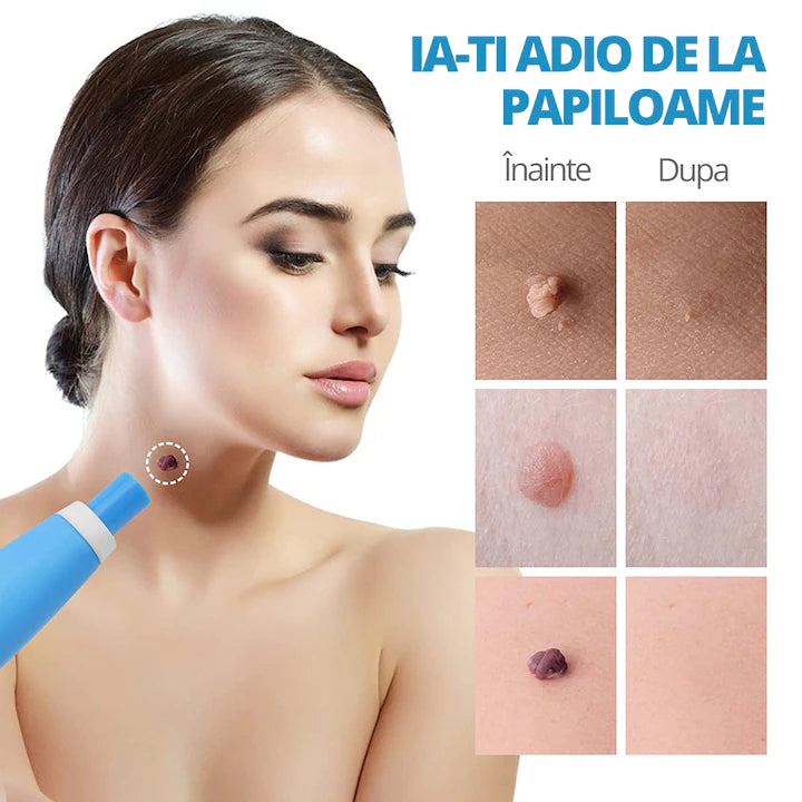 Dispozitiv indepartare papiloame LittleDomi kit skin tag fata gat corp 2 8 mm