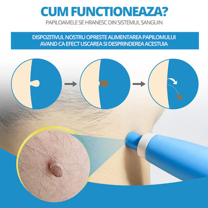Dispozitiv indepartare papiloame LittleDomi kit skin tag fata gat corp 2 8 mm