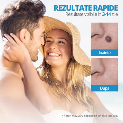 Dispozitiv indepartare papiloame LittleDomi kit skin tag fata gat corp 2 8 mm